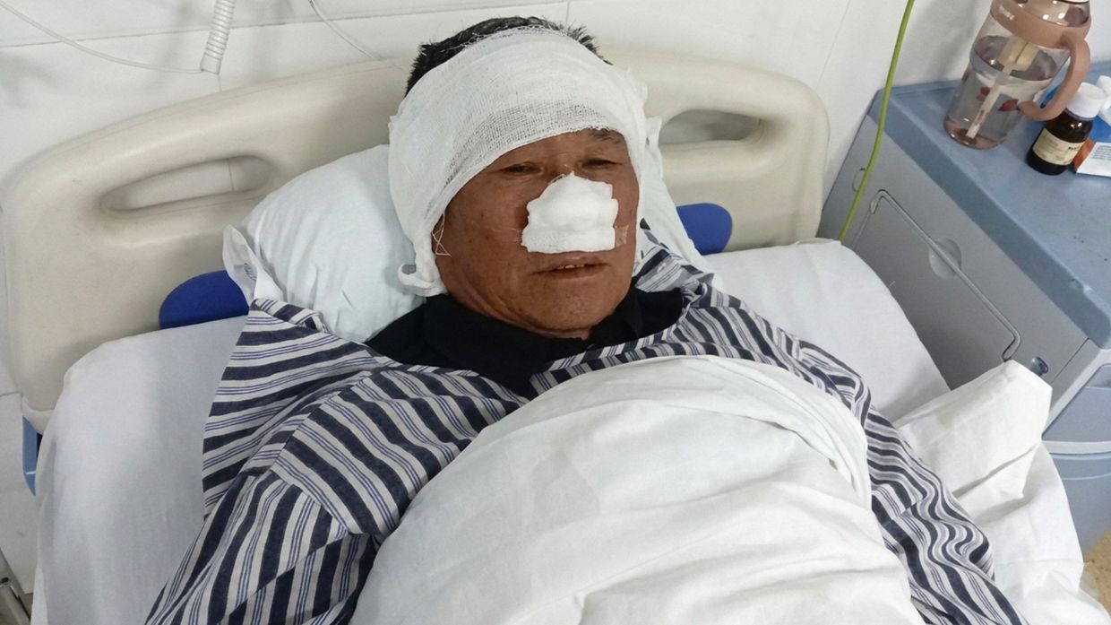 Chinese retiree loses nose saving woman from attacker, named national hero