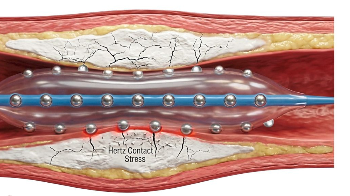 Malaysian doctors test new device to crack hardened heart artery blockages