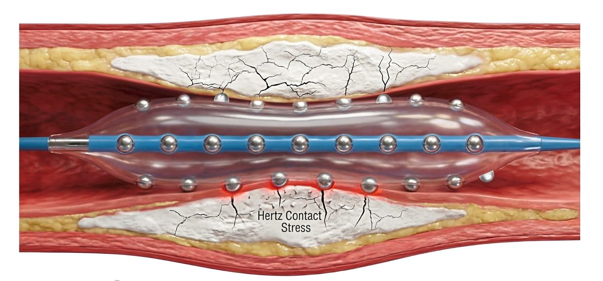 Malaysian doctors test new device to crack hardened heart artery blockages